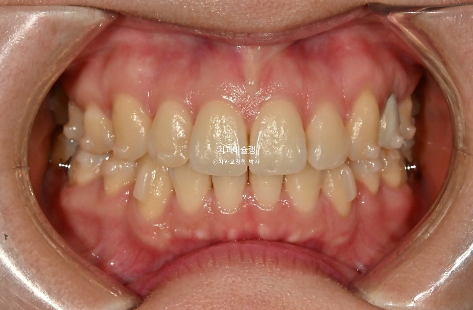 돌출입 발치교정 개방교합 무턱 재교정 인비절라인 입술부전증 치료기간 2년8개월 재제작 2회