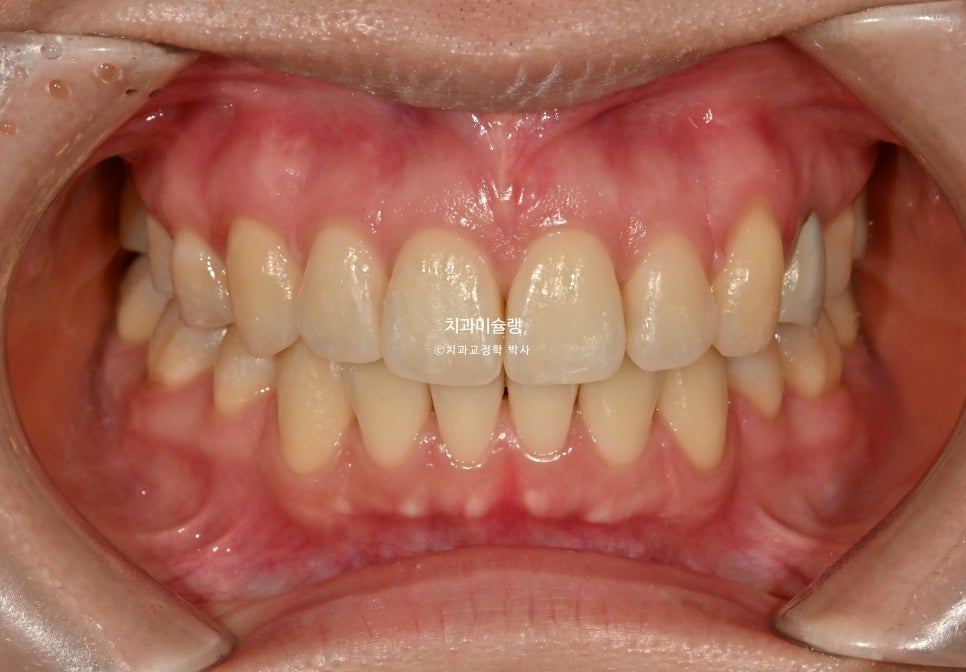돌출입 발치교정 개방교합 무턱 재교정 인비절라인 입술부전증 치료기간 2년8개월 재제작 2회
