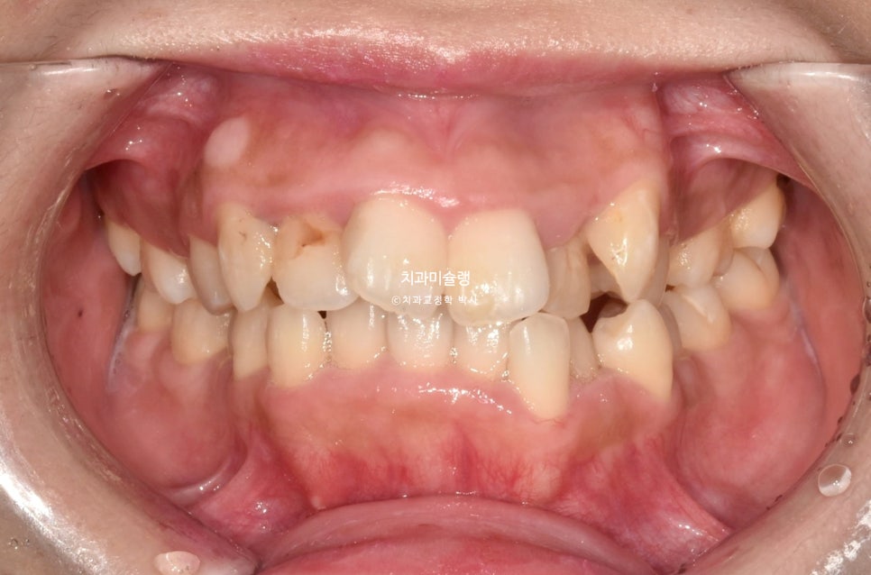 덧니 반대교합 발치 교정 인비절라인 치료기간 2년4개월 재제작 1회
