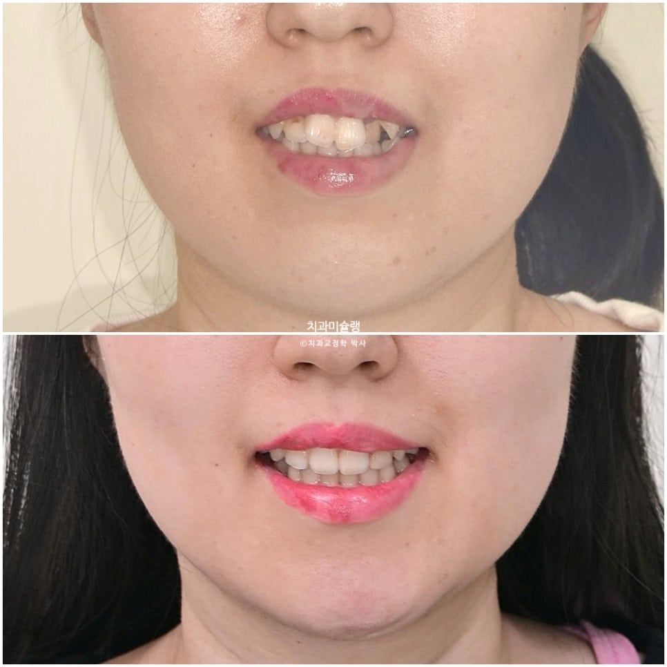 덧니 반대교합 발치 교정 인비절라인 치료기간 2년4개월 재제작 1회