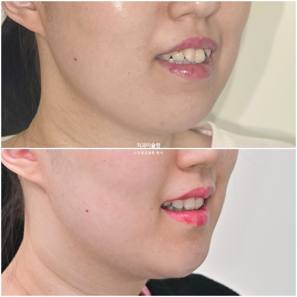 덧니 반대교합 발치 교정 인비절라인 치료기간 2년4개월 재제작 1회