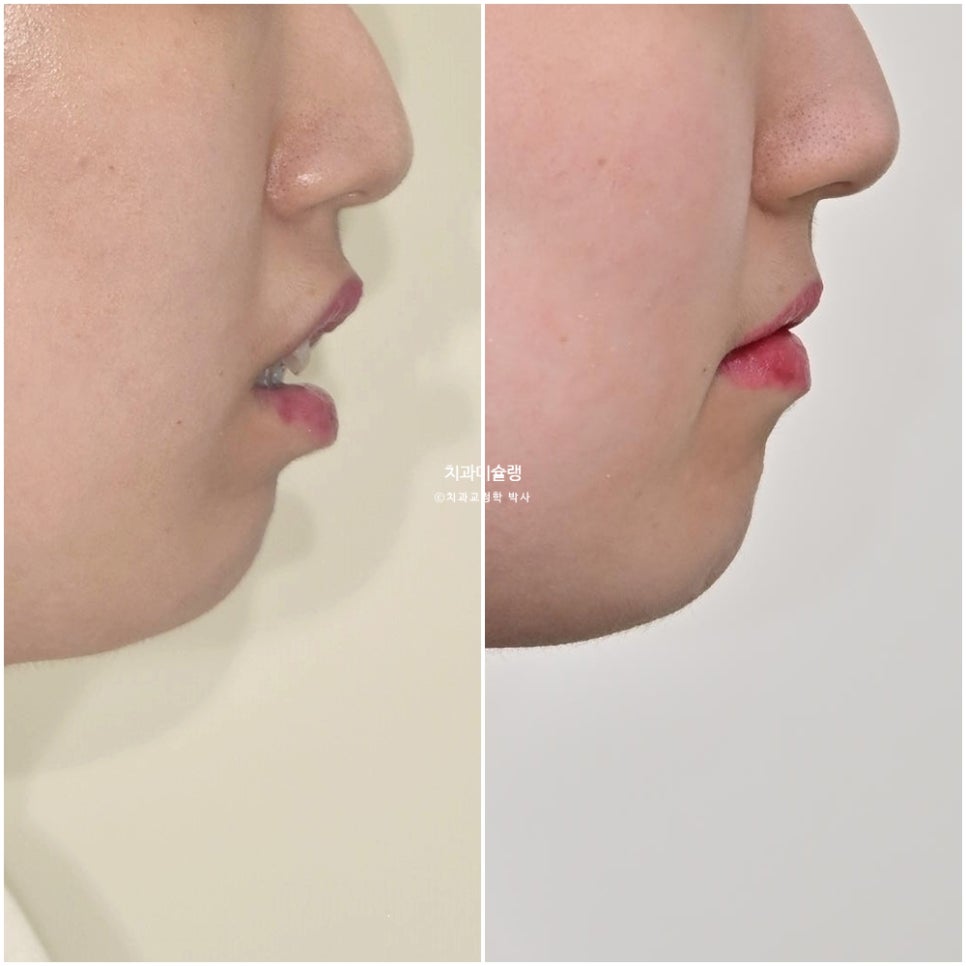 덧니 반대교합 발치 교정 인비절라인 치료기간 2년4개월 재제작 1회