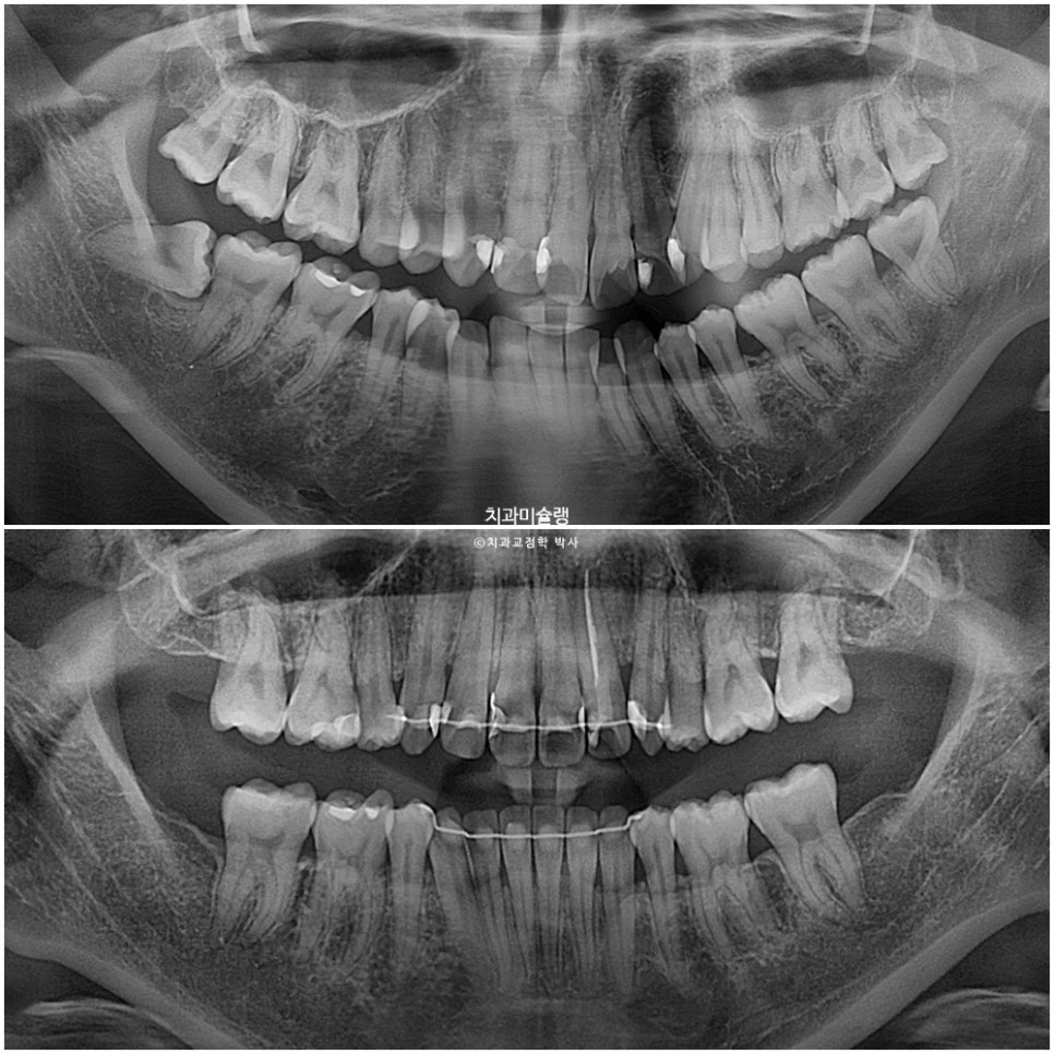 덧니 반대교합 발치 교정 인비절라인 치료기간 2년4개월 재제작 1회