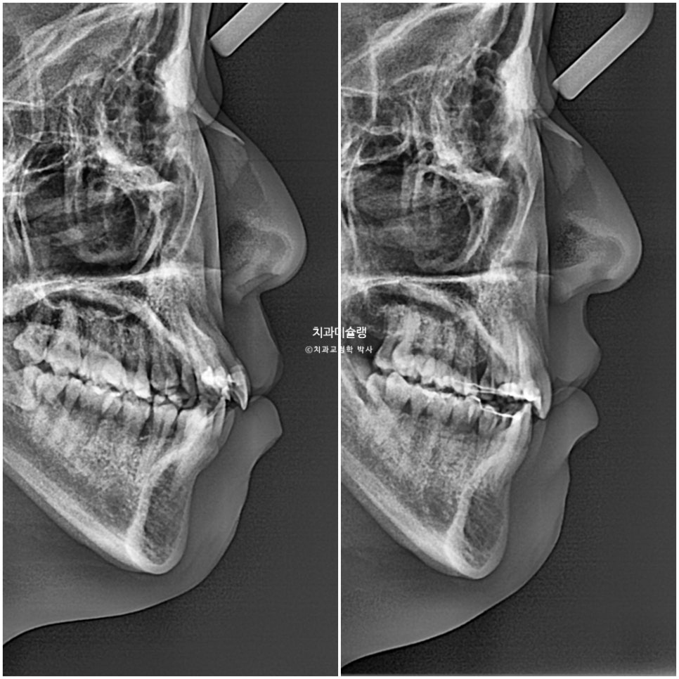 덧니 반대교합 발치 교정 인비절라인 치료기간 2년4개월 재제작 1회