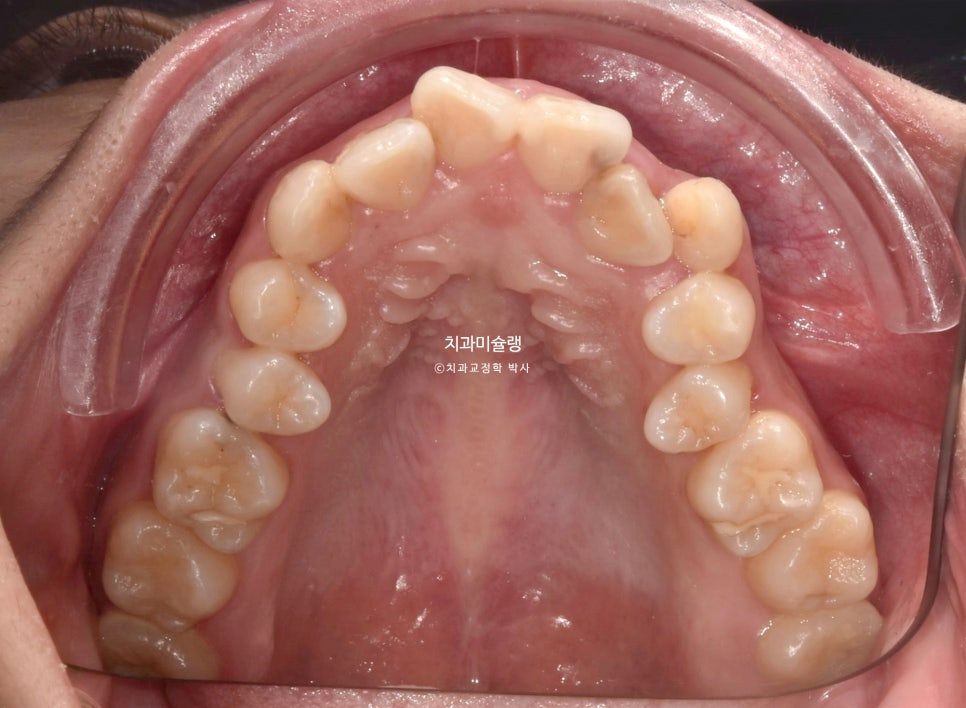 덧니 반대교합 발치 교정 인비절라인 치료기간 2년4개월 재제작 1회