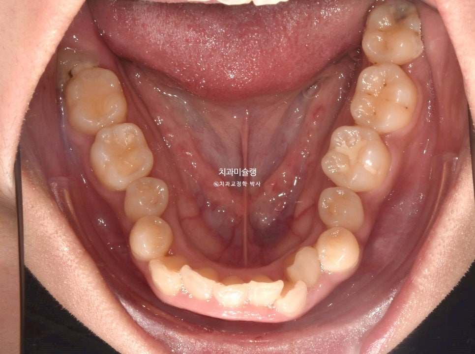 덧니 반대교합 발치 교정 인비절라인 치료기간 2년4개월 재제작 1회