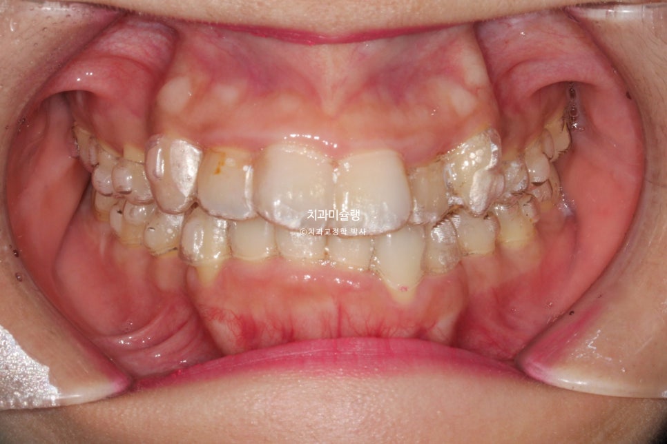 덧니 반대교합 발치 교정 인비절라인 치료기간 2년4개월 재제작 1회