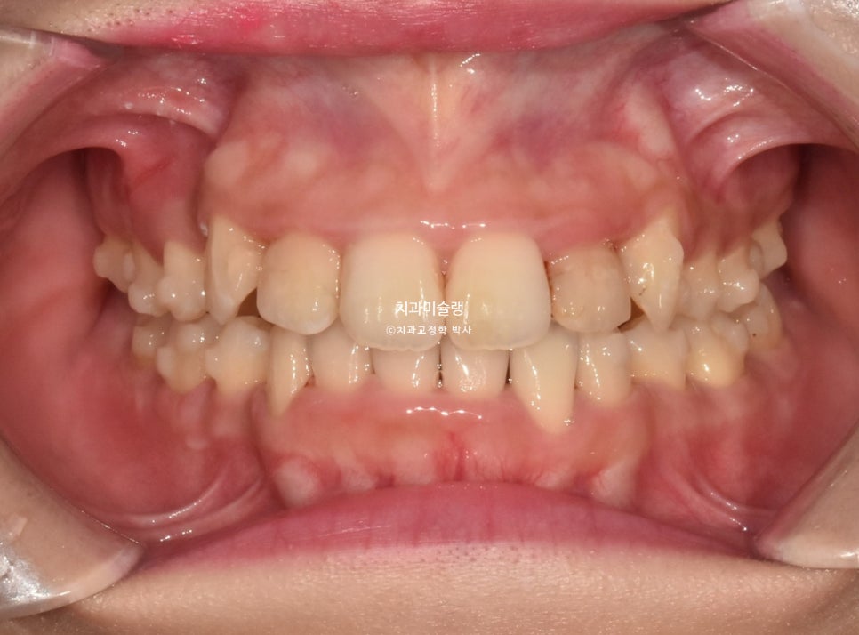 덧니 반대교합 발치 교정 인비절라인 치료기간 2년4개월 재제작 1회