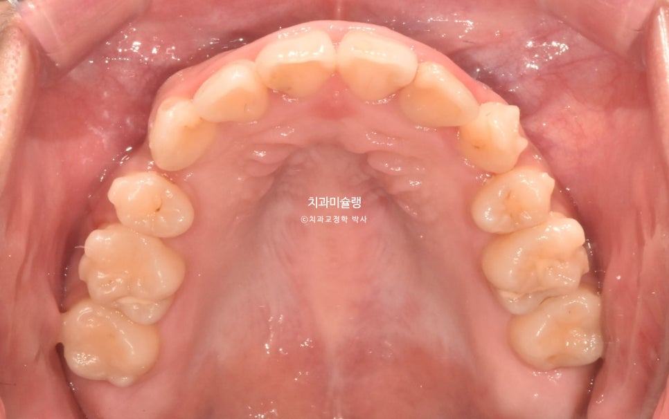 덧니 반대교합 발치 교정 인비절라인 치료기간 2년4개월 재제작 1회