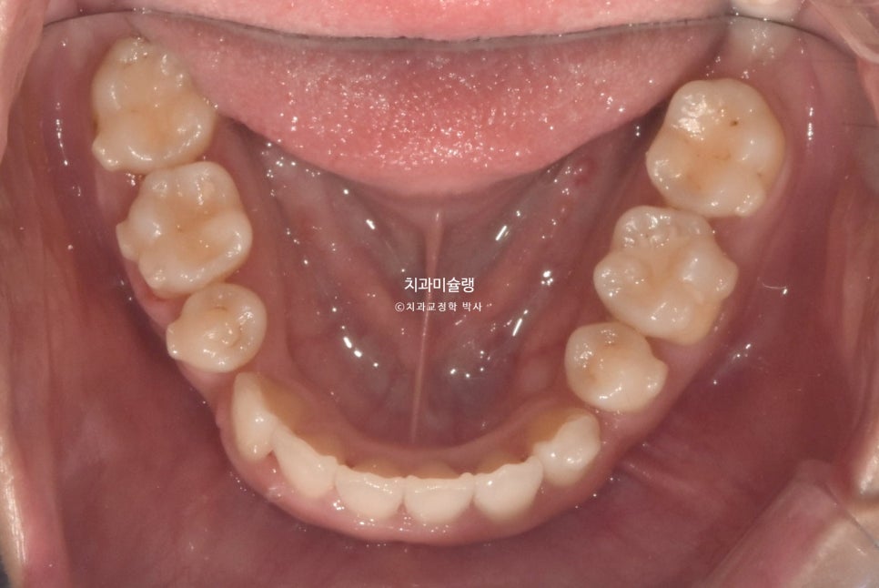 덧니 반대교합 발치 교정 인비절라인 치료기간 2년4개월 재제작 1회
