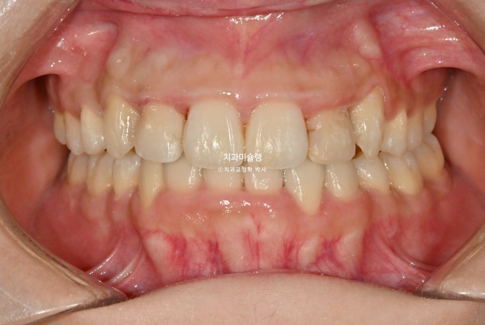 덧니 반대교합 발치 교정 인비절라인 치료기간 2년4개월 재제작 1회