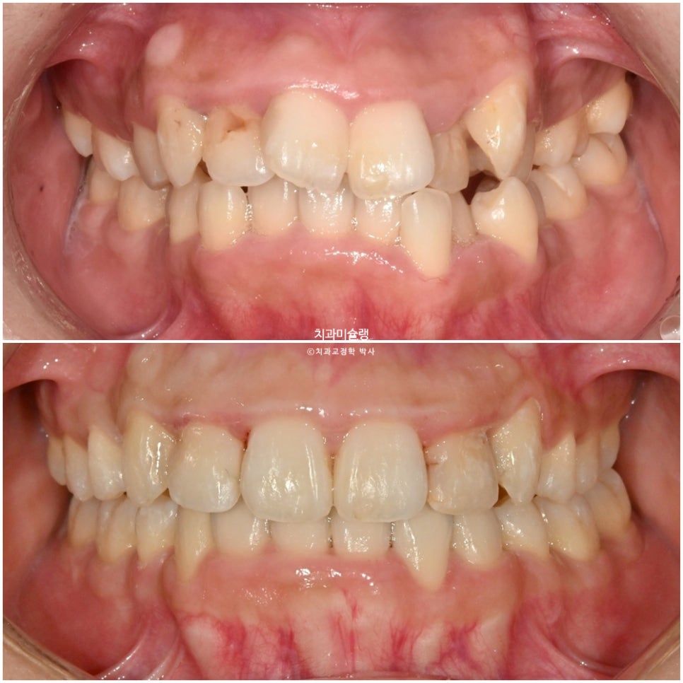 덧니 반대교합 발치 교정 인비절라인 치료기간 2년4개월 재제작 1회