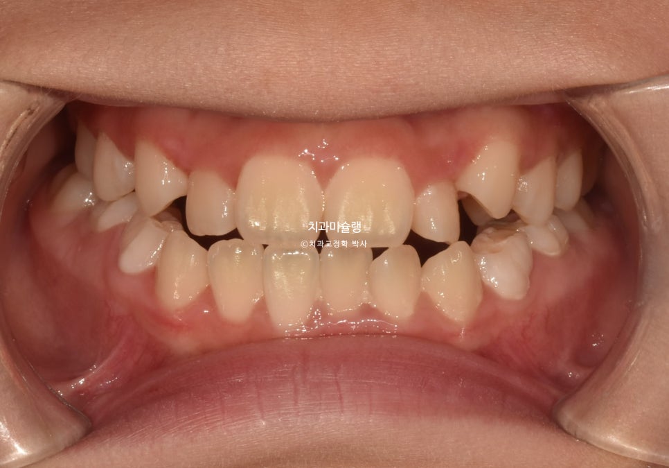 어린이 투명교정 인비절라인 퍼스트 3급 고무줄 주걱턱 덧니 반대교합 개방교합 부정교합 치료 1년 9개월 재제작 2회