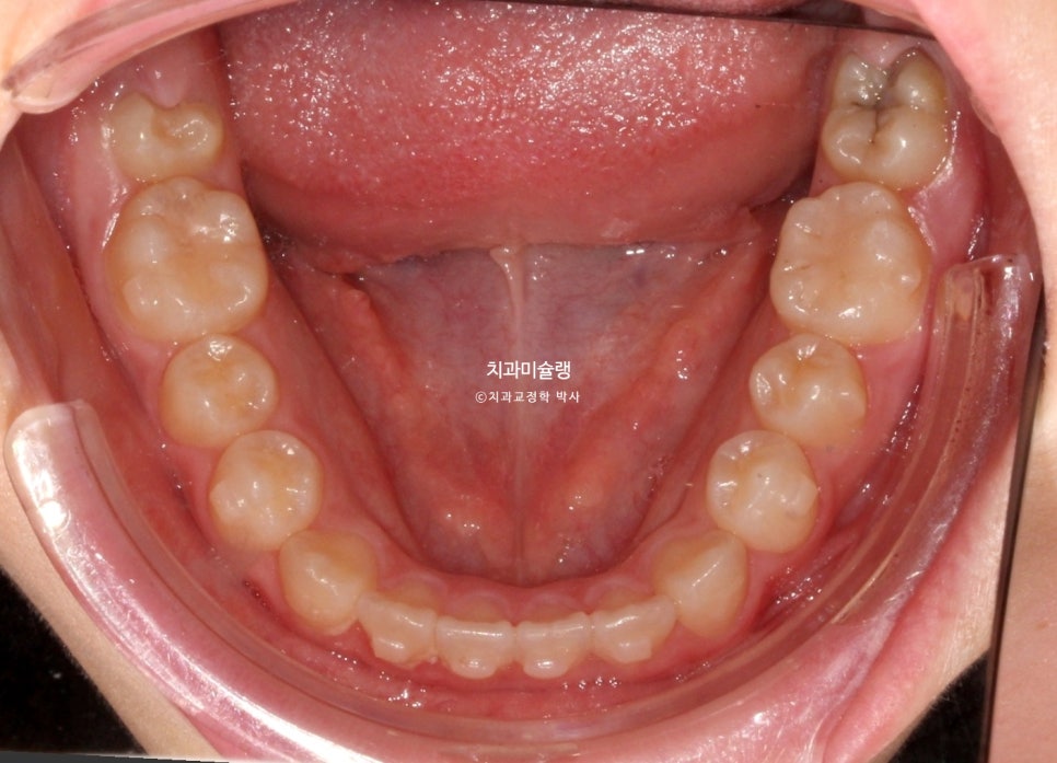 어린이 투명교정 인비절라인 퍼스트 3급 고무줄 주걱턱 덧니 반대교합 개방교합 부정교합 치료 1년 9개월 재제작 2회