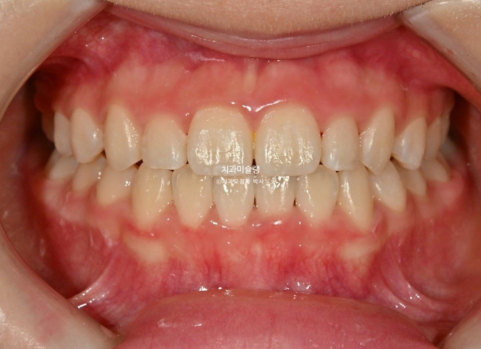 어린이 투명교정 인비절라인 퍼스트 3급 고무줄 주걱턱 덧니 반대교합 개방교합 부정교합 치료 1년 9개월 재제작 2회