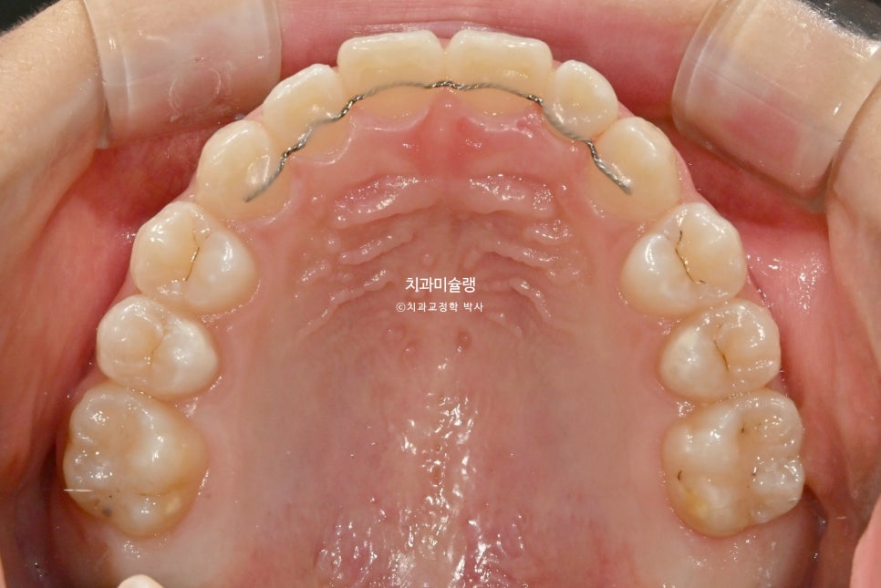 어린이 투명교정 인비절라인 퍼스트 3급 고무줄 주걱턱 덧니 반대교합 개방교합 부정교합 치료 1년 9개월 재제작 2회