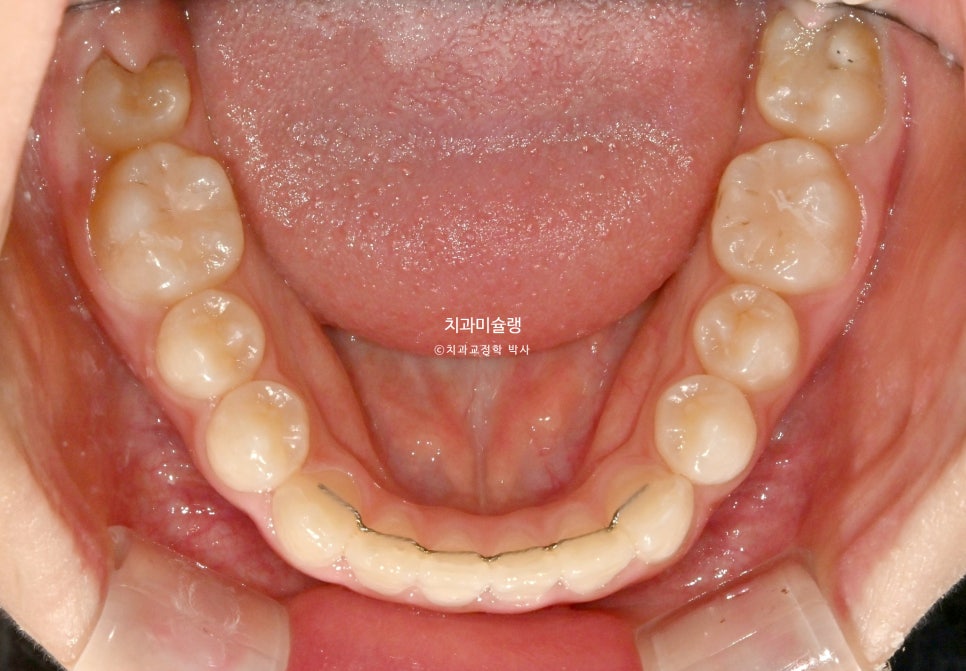 어린이 투명교정 인비절라인 퍼스트 3급 고무줄 주걱턱 덧니 반대교합 개방교합 부정교합 치료 1년 9개월 재제작 2회