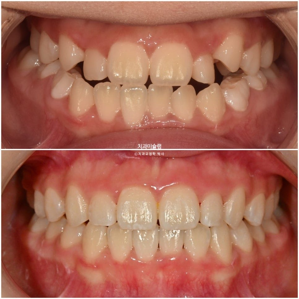어린이 투명교정 인비절라인 퍼스트 3급 고무줄 주걱턱 덧니 반대교합 개방교합 부정교합 치료 1년 9개월 재제작 2회