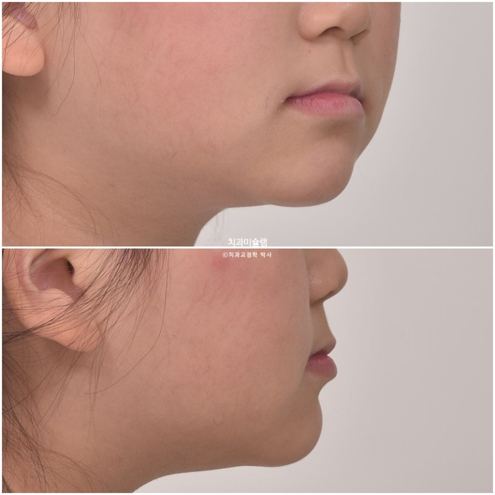 어린이 투명교정 인비절라인 퍼스트 3급 고무줄 주걱턱 덧니 반대교합 개방교합 부정교합 치료 1년 9개월 재제작 2회