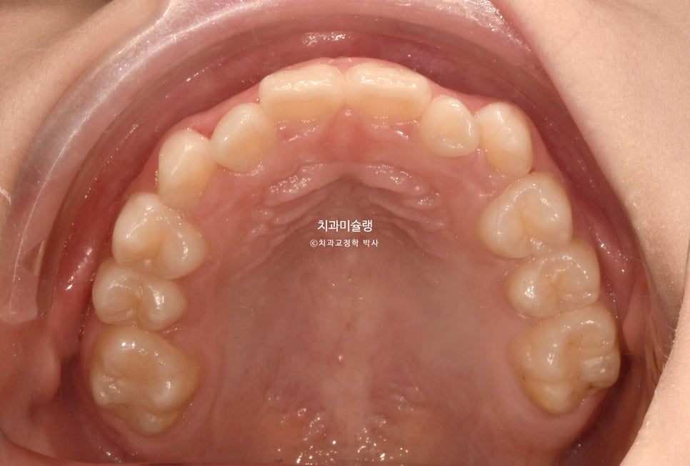 어린이 투명교정 인비절라인 퍼스트 3급 고무줄 주걱턱 덧니 반대교합 개방교합 부정교합 치료 1년 9개월 재제작 2회