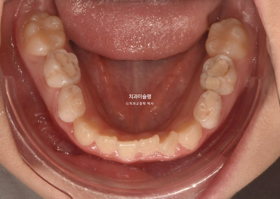 어린이 투명교정 인비절라인 퍼스트 3급 고무줄 주걱턱 덧니 반대교합 개방교합 부정교합 치료 1년 9개월 재제작 2회