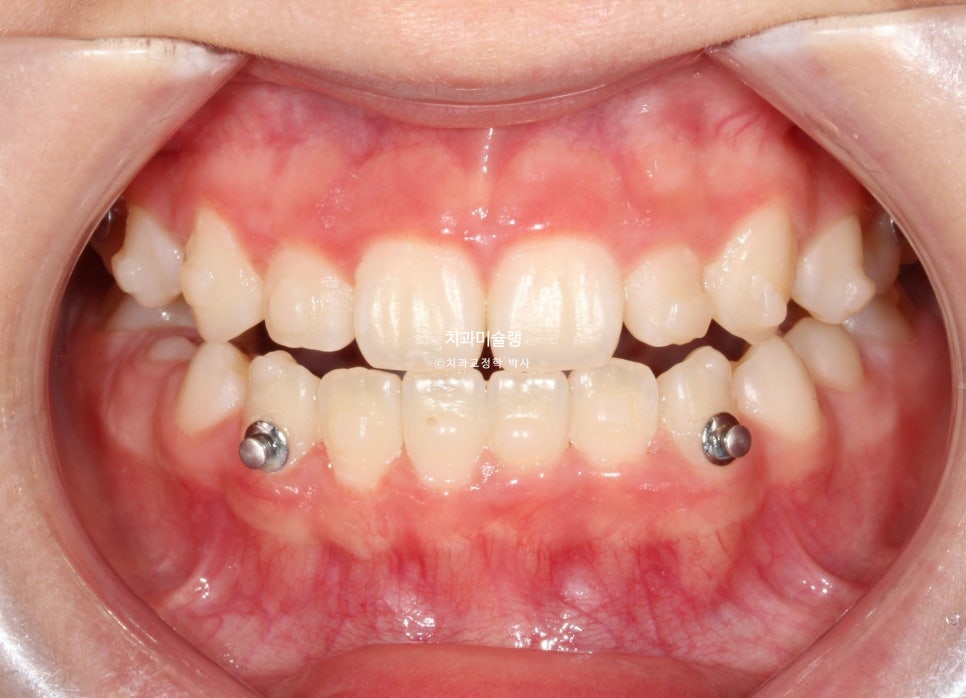 어린이 투명교정 인비절라인 퍼스트 3급 고무줄 주걱턱 덧니 반대교합 개방교합 부정교합 치료 1년 9개월 재제작 2회