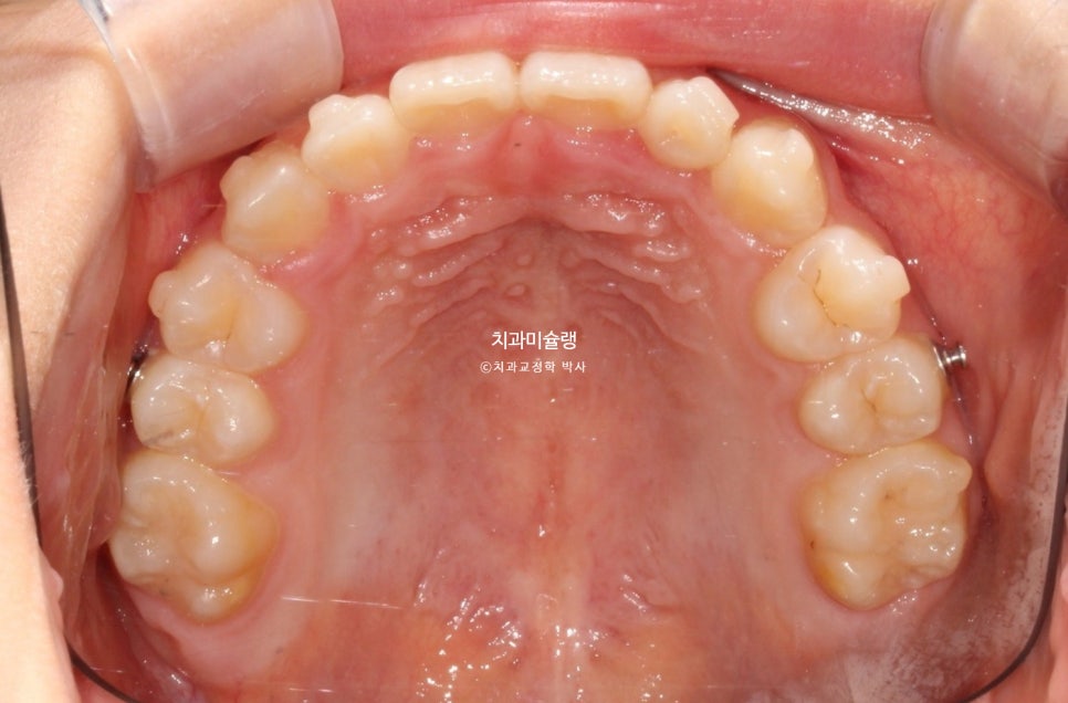 어린이 투명교정 인비절라인 퍼스트 3급 고무줄 주걱턱 덧니 반대교합 개방교합 부정교합 치료 1년 9개월 재제작 2회