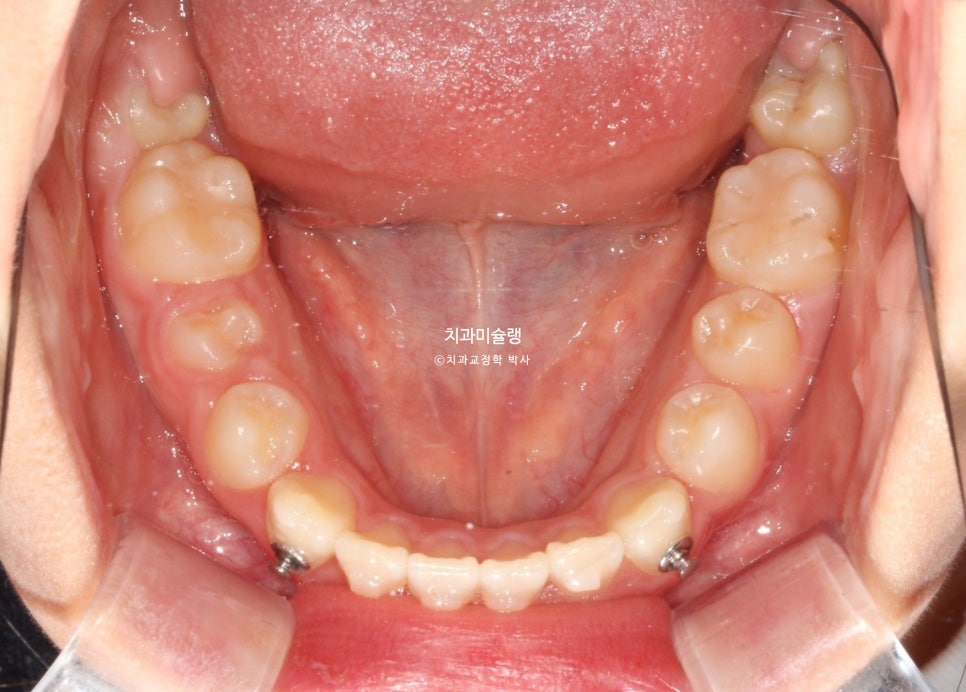 어린이 투명교정 인비절라인 퍼스트 3급 고무줄 주걱턱 덧니 반대교합 개방교합 부정교합 치료 1년 9개월 재제작 2회