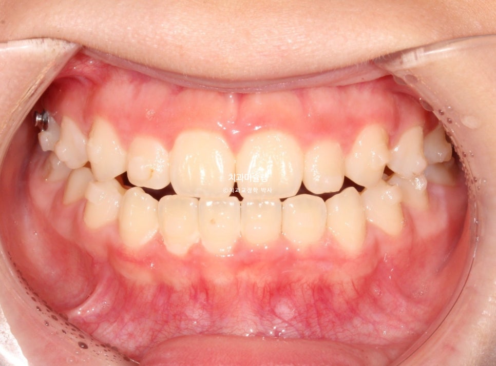 어린이 투명교정 인비절라인 퍼스트 3급 고무줄 주걱턱 덧니 반대교합 개방교합 부정교합 치료 1년 9개월 재제작 2회