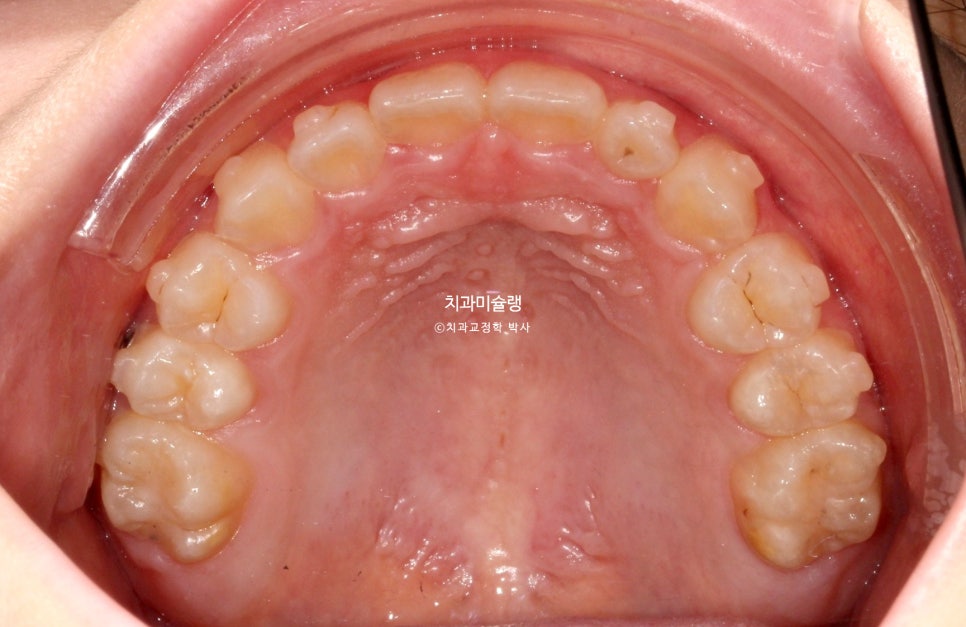 어린이 투명교정 인비절라인 퍼스트 3급 고무줄 주걱턱 덧니 반대교합 개방교합 부정교합 치료 1년 9개월 재제작 2회
