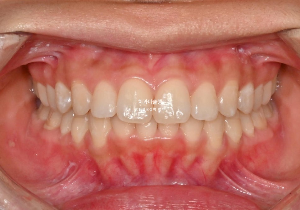 턱관절 환자의 비발치 돌출입 재교정 인비절라인 부작용 클리피씨 돌출 입술부전증 미니스크류 치료기간 1년 2개월