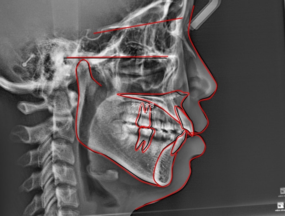 턱관절 환자의 비발치 돌출입 재교정 인비절라인 부작용 클리피씨 돌출 입술부전증 미니스크류 치료기간 1년 2개월