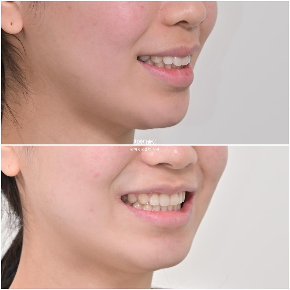 턱관절 환자의 비발치 돌출입 재교정 인비절라인 부작용 클리피씨 돌출 입술부전증 미니스크류 치료기간 1년 2개월