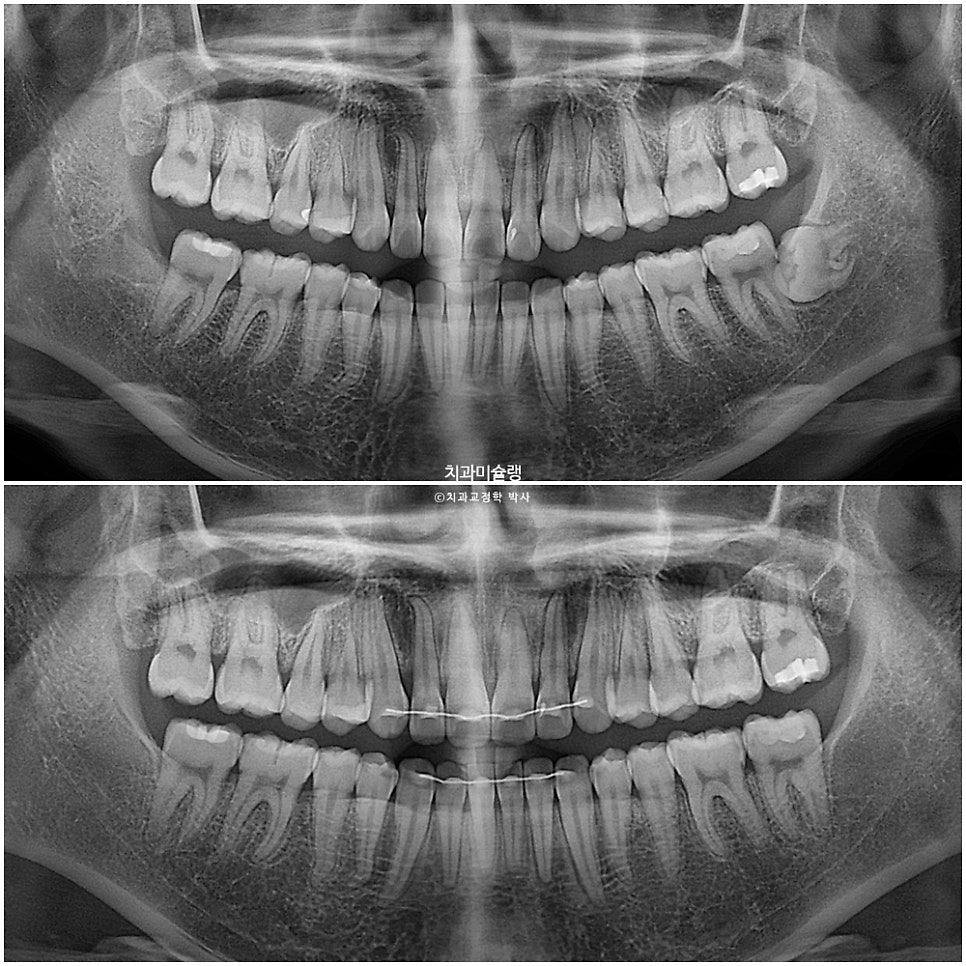 턱관절 환자의 비발치 돌출입 재교정 인비절라인 부작용 클리피씨 돌출 입술부전증 미니스크류 치료기간 1년 2개월