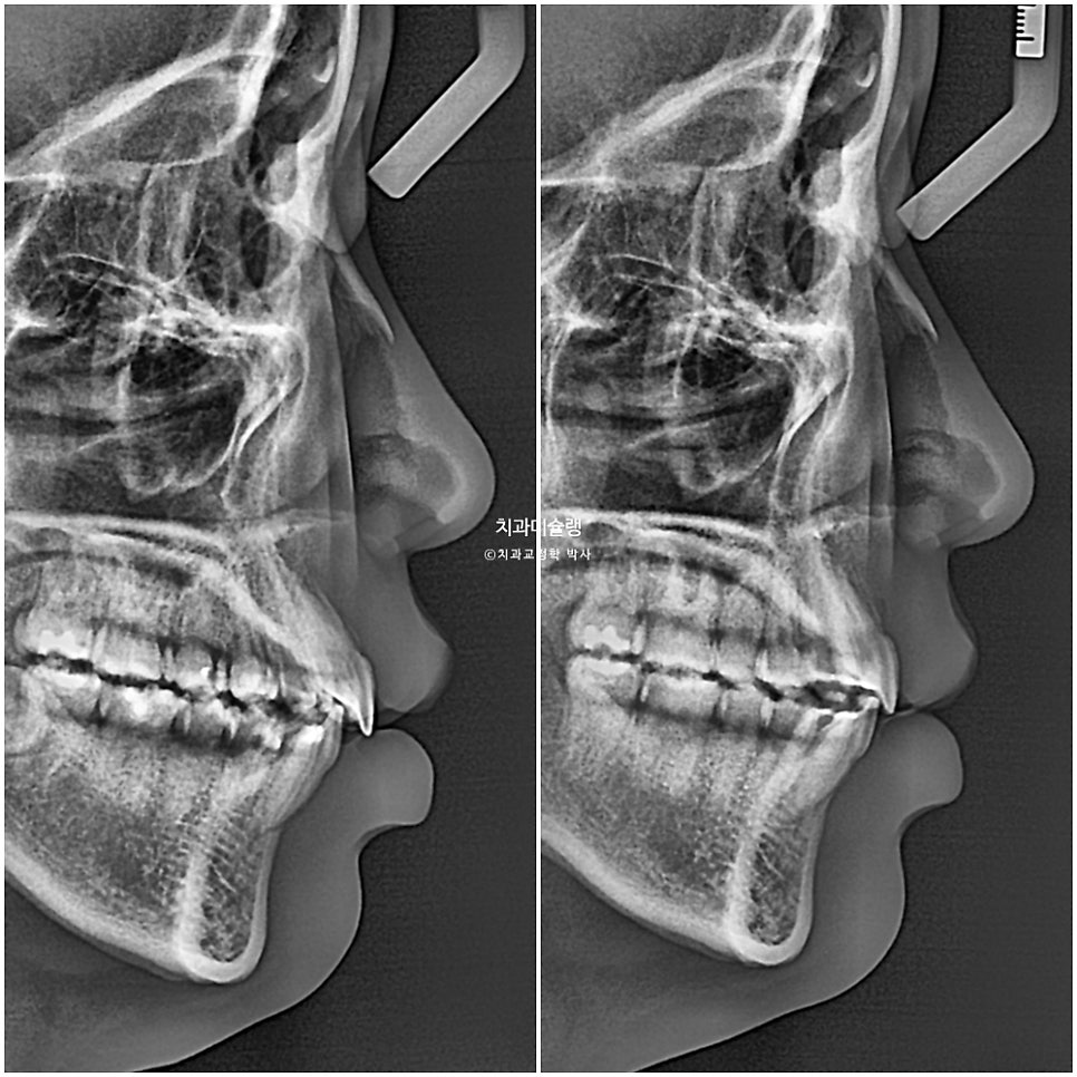 턱관절 환자의 비발치 돌출입 재교정 인비절라인 부작용 클리피씨 돌출 입술부전증 미니스크류 치료기간 1년 2개월