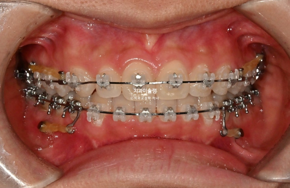 턱관절 환자의 비발치 돌출입 재교정 인비절라인 부작용 클리피씨 돌출 입술부전증 미니스크류 치료기간 1년 2개월