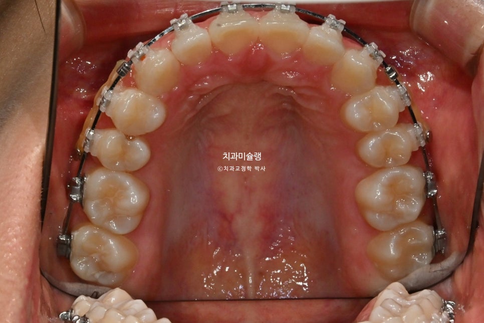 턱관절 환자의 비발치 돌출입 재교정 인비절라인 부작용 클리피씨 돌출 입술부전증 미니스크류 치료기간 1년 2개월