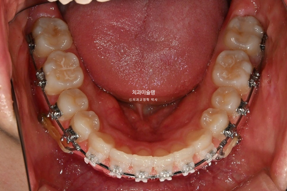 턱관절 환자의 비발치 돌출입 재교정 인비절라인 부작용 클리피씨 돌출 입술부전증 미니스크류 치료기간 1년 2개월
