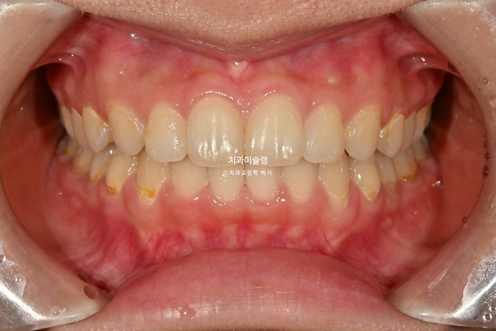 턱관절 환자의 비발치 돌출입 재교정 인비절라인 부작용 클리피씨 돌출 입술부전증 미니스크류 치료기간 1년 2개월