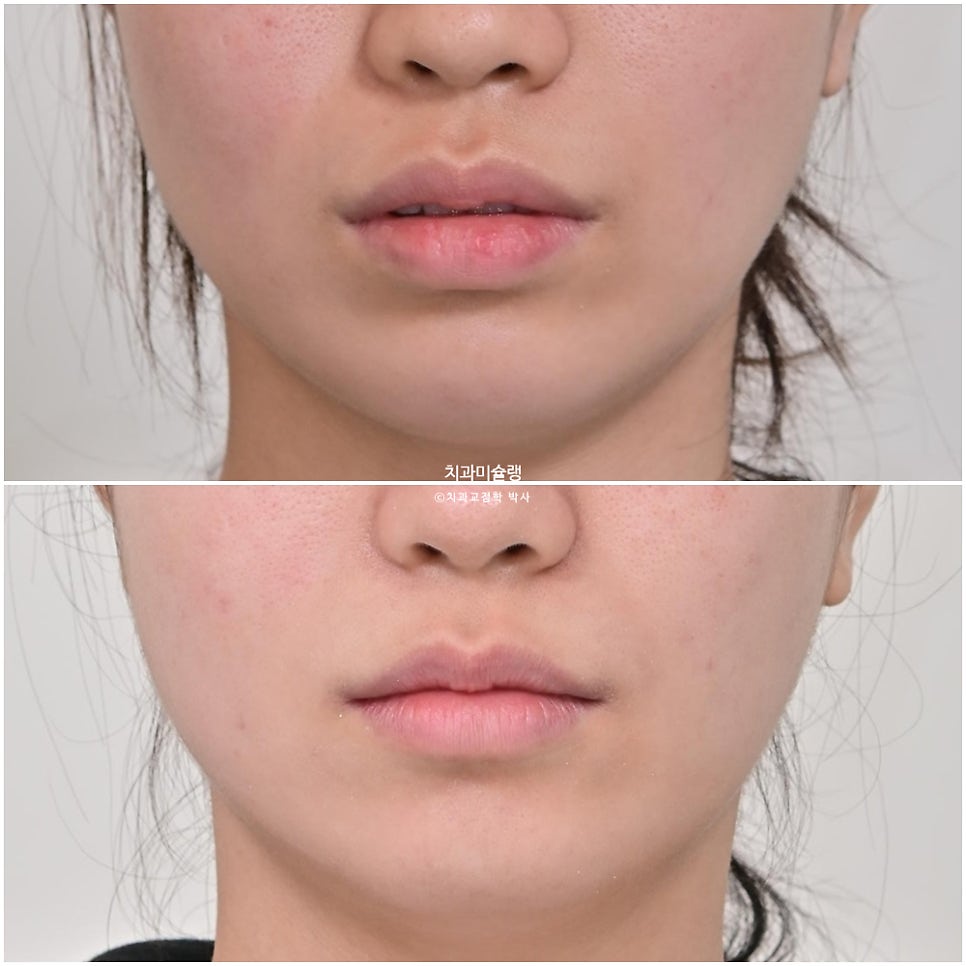 턱관절 환자의 비발치 돌출입 재교정 인비절라인 부작용 클리피씨 돌출 입술부전증 미니스크류 치료기간 1년 2개월