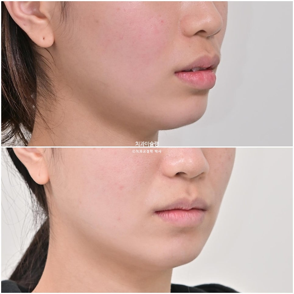 턱관절 환자의 비발치 돌출입 재교정 인비절라인 부작용 클리피씨 돌출 입술부전증 미니스크류 치료기간 1년 2개월