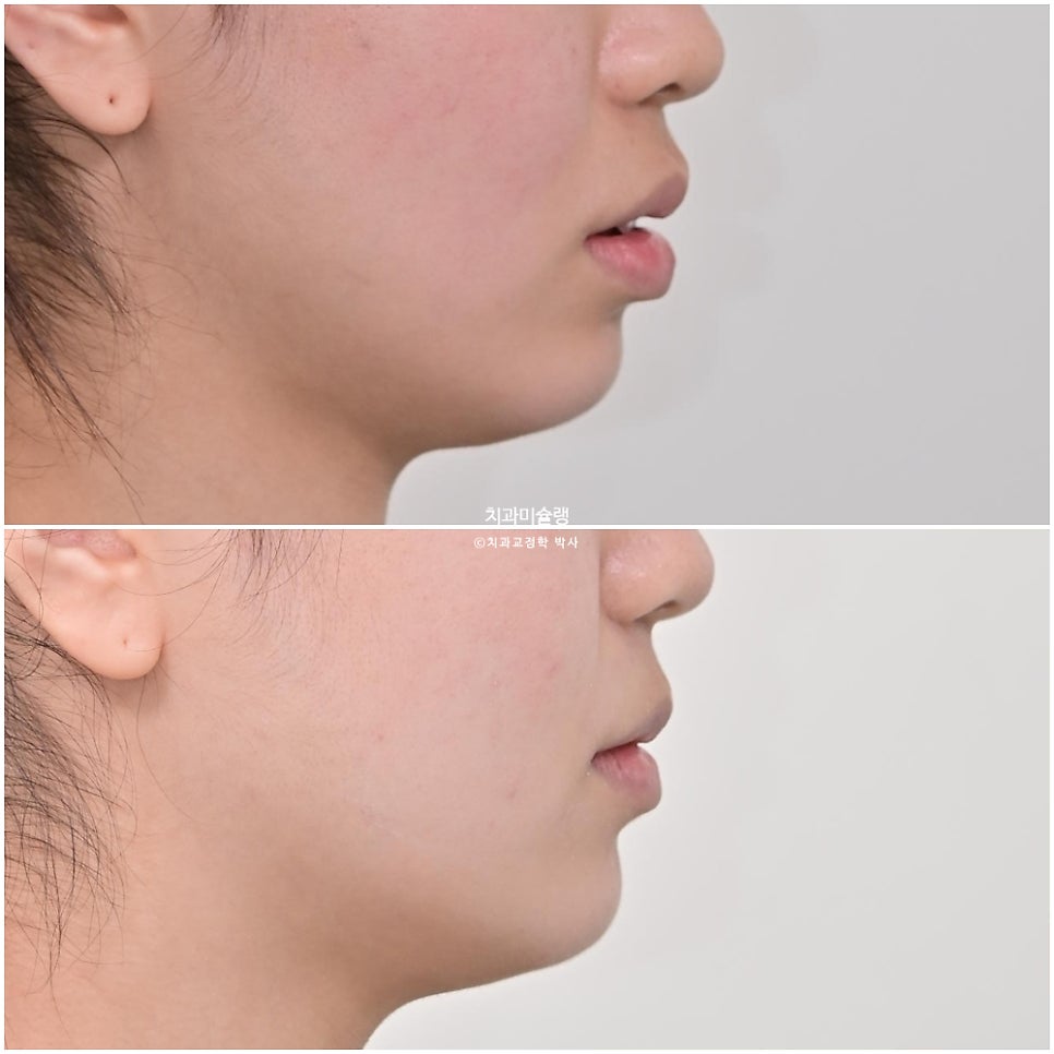턱관절 환자의 비발치 돌출입 재교정 인비절라인 부작용 클리피씨 돌출 입술부전증 미니스크류 치료기간 1년 2개월