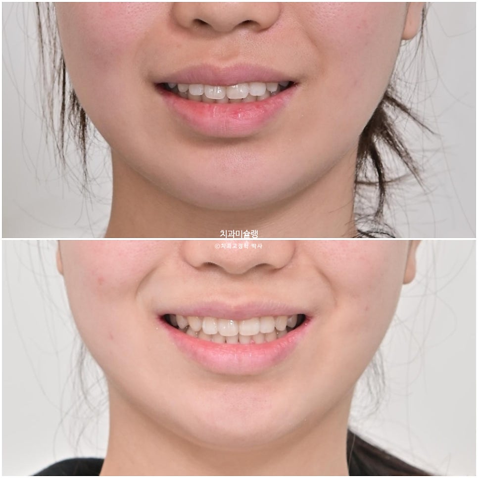 턱관절 환자의 비발치 돌출입 재교정 인비절라인 부작용 클리피씨 돌출 입술부전증 미니스크류 치료기간 1년 2개월