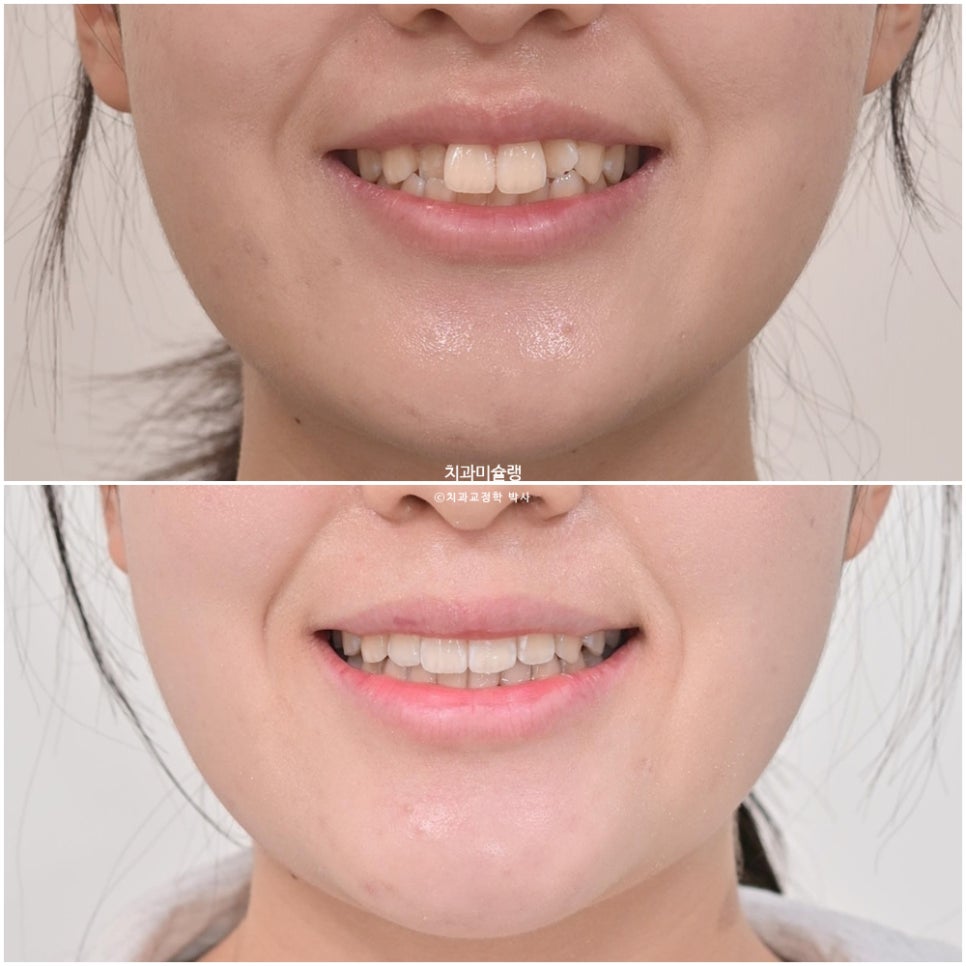 비발치 덧니 반대교합 후방이동 인비절라인 교정 중심선 치료기간 1년 6개월 재제작 1회