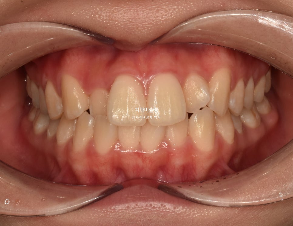 비발치 덧니 반대교합 후방이동 인비절라인 교정 중심선 치료기간 1년 6개월 재제작 1회