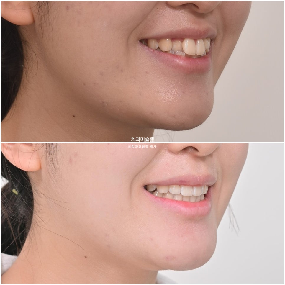 비발치 덧니 반대교합 후방이동 인비절라인 교정 중심선 치료기간 1년 6개월 재제작 1회