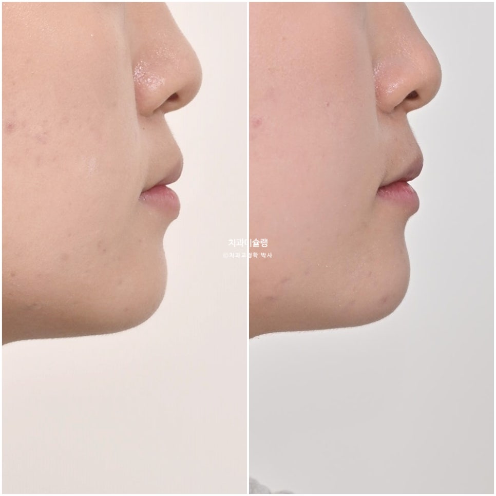 비발치 덧니 반대교합 후방이동 인비절라인 교정 중심선 치료기간 1년 6개월 재제작 1회