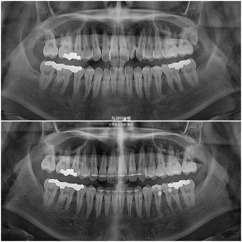 비발치 덧니 반대교합 후방이동 인비절라인 교정 중심선 치료기간 1년 6개월 재제작 1회