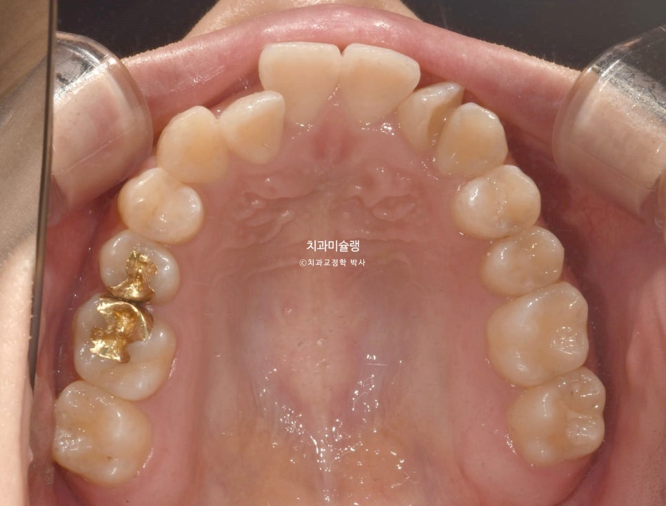 비발치 덧니 반대교합 후방이동 인비절라인 교정 중심선 치료기간 1년 6개월 재제작 1회