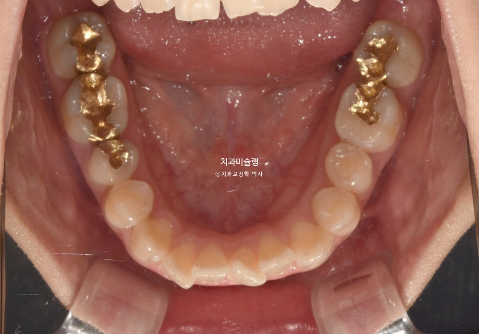 비발치 덧니 반대교합 후방이동 인비절라인 교정 중심선 치료기간 1년 6개월 재제작 1회